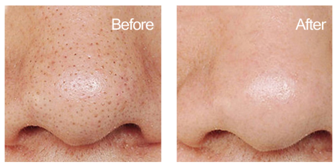Hydra Dermabrasion